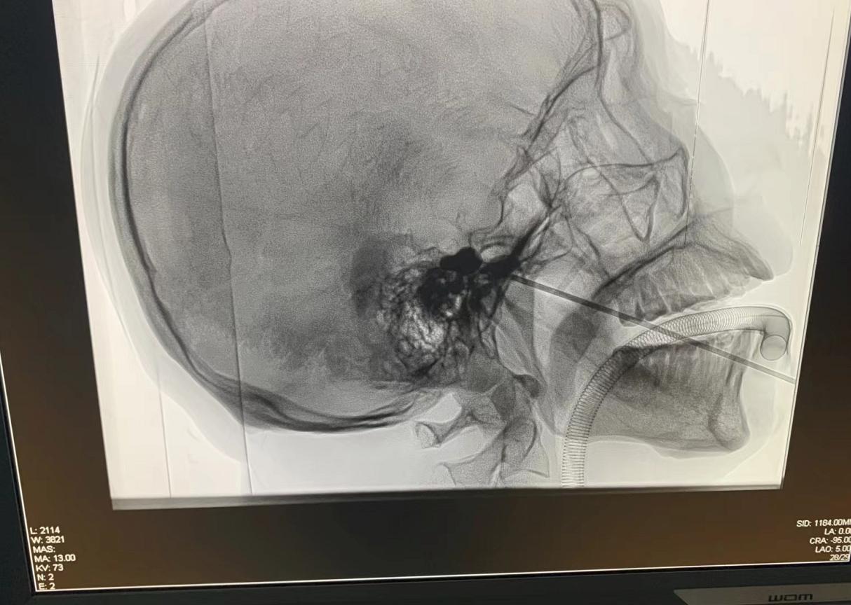 郴州市支气管球囊扩张,小球囊解决大问题