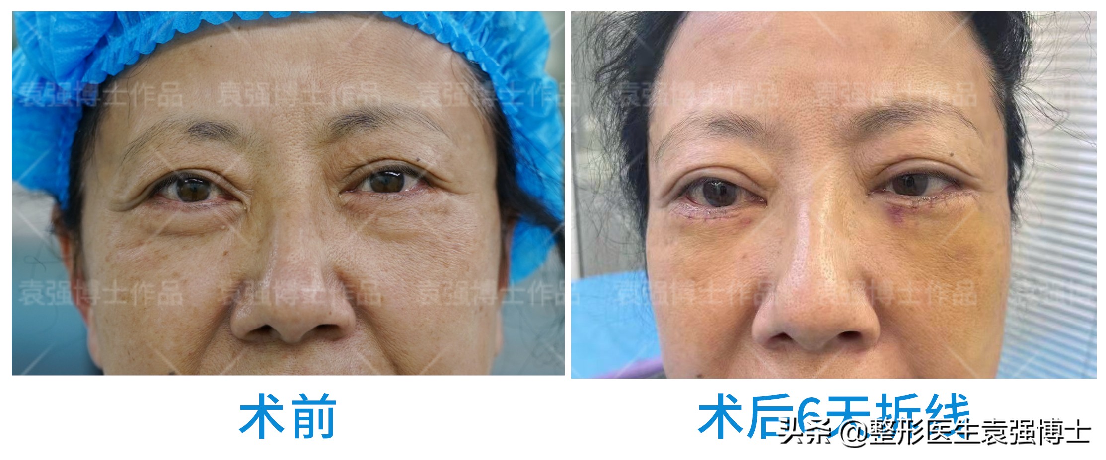 想彻底解决眼袋,想做除眼袋手术怎么和医生沟通