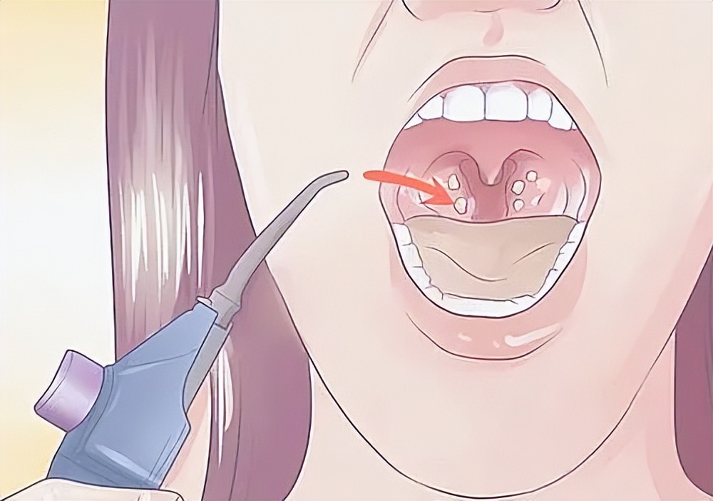 喉咙有异物感咳一下喉咙容易出血,喉咙有异物咳出水老是想咳