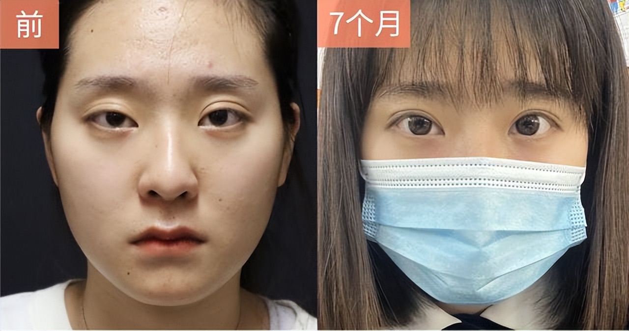 割双眼皮成了大小眼怎么办,双眼皮术后大小眼是什么原因