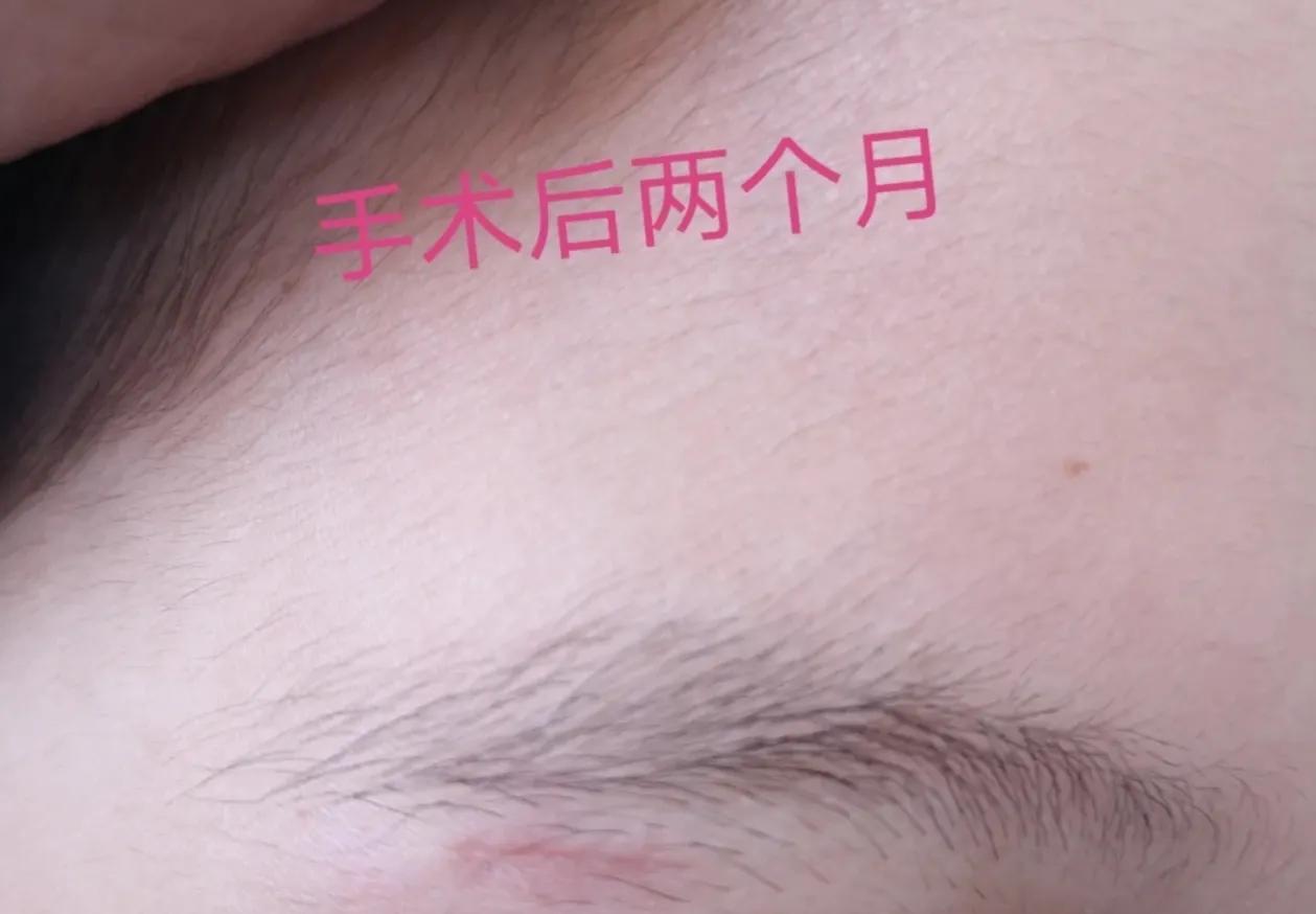 孩子头部皮脂腺囊肿能保守治疗吗,孩子面部皮脂腺囊肿