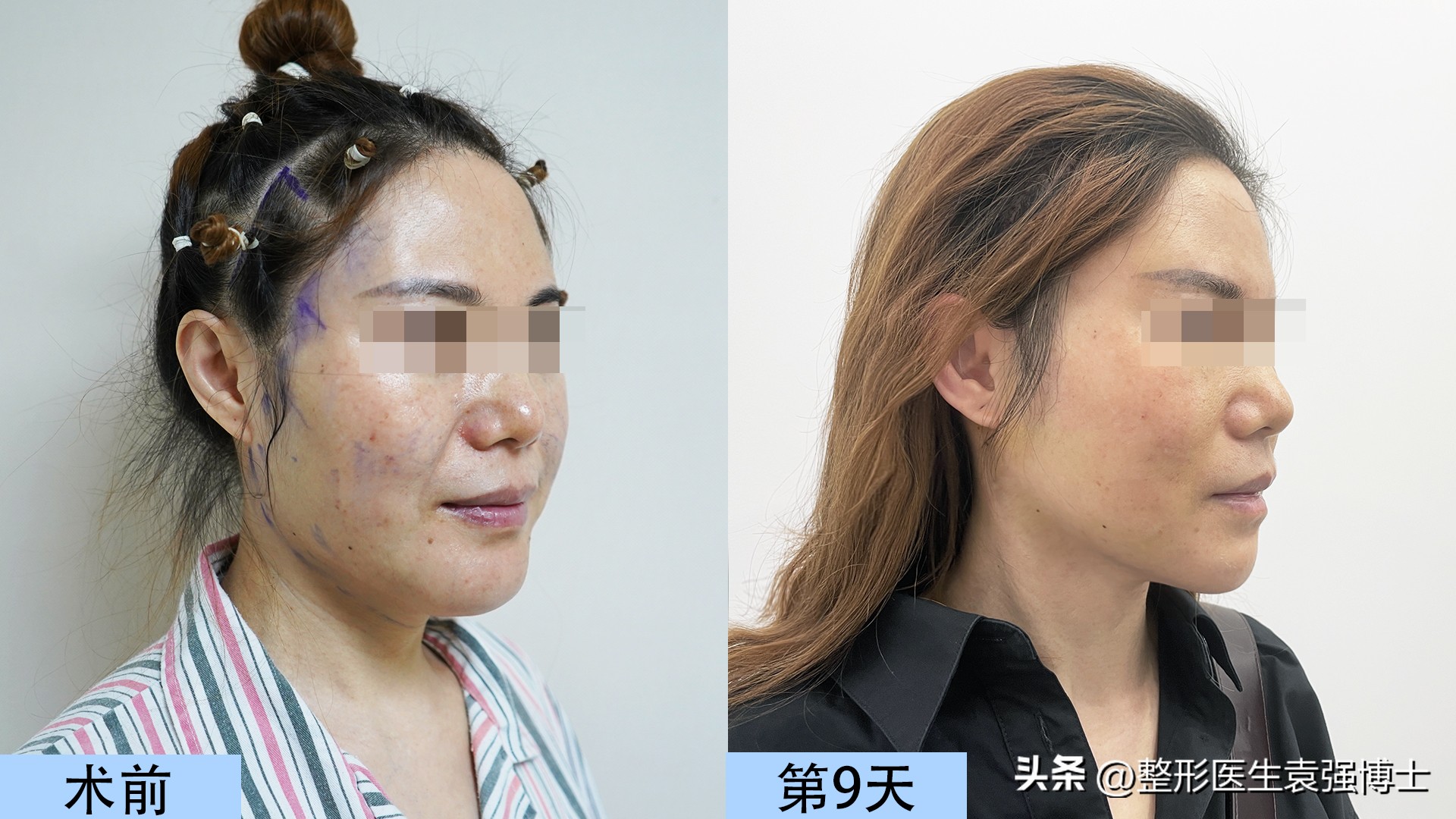 55岁后适合做拉皮手术吗,60岁适合做拉皮手术吗