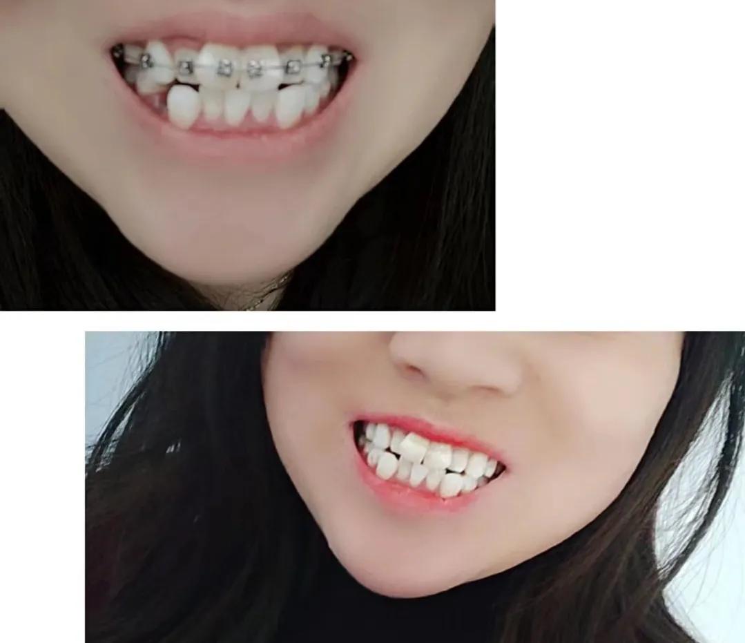 30岁牙齿缺失再矫正的弊端,30岁牙齿不齐怎么矫正