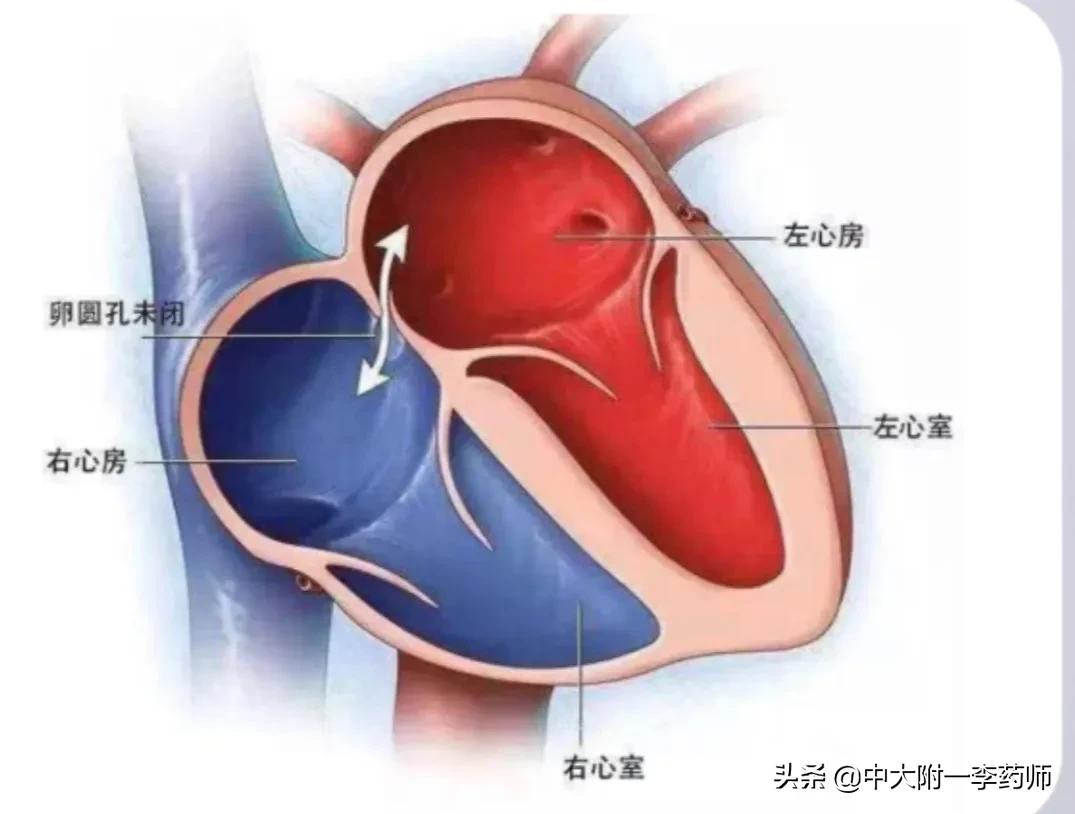 女子头痛56年查出心脏有个洞，据调查：约四分之一的成人有这个洞