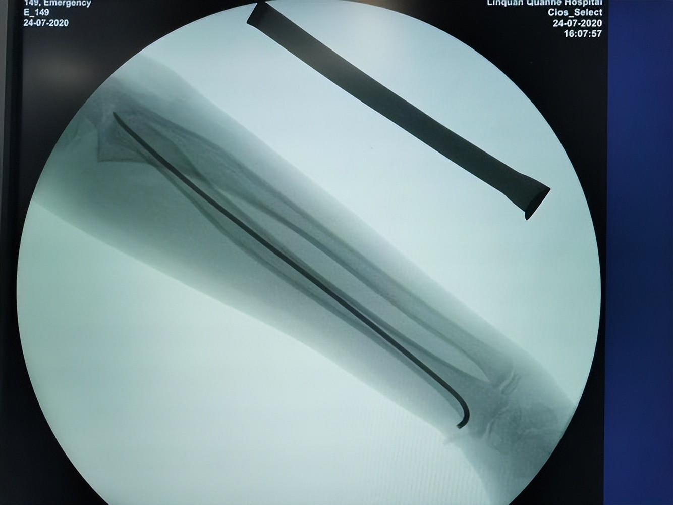 儿童股骨干粉碎性骨折对位不太好,儿童股骨干骨折石膏固定