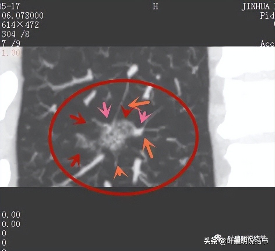 误诊肺纤维化,肺蜂窝状是癌吗