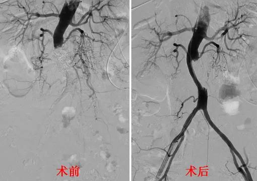 宜宾首例！华西宜宾医院成功采用Shockwave外周血管内冲击波技术治疗腹主动脉重度钙化闭塞病变