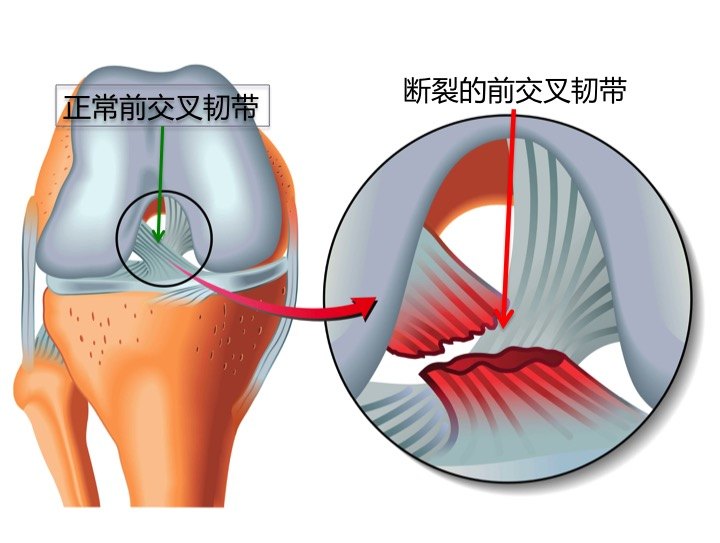 膝关节常见损伤场景和预防,常见的膝关节损伤及相关动作障碍