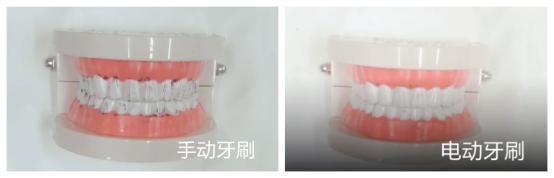 电动牙刷的好处与坏处有哪些,电动牙刷的好处与坏处