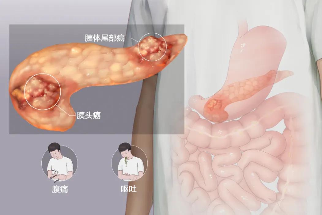 胰腺癌化疗之后皮肤瘙痒怎么回事,胰腺癌手术切除后皮肤瘙痒为什么