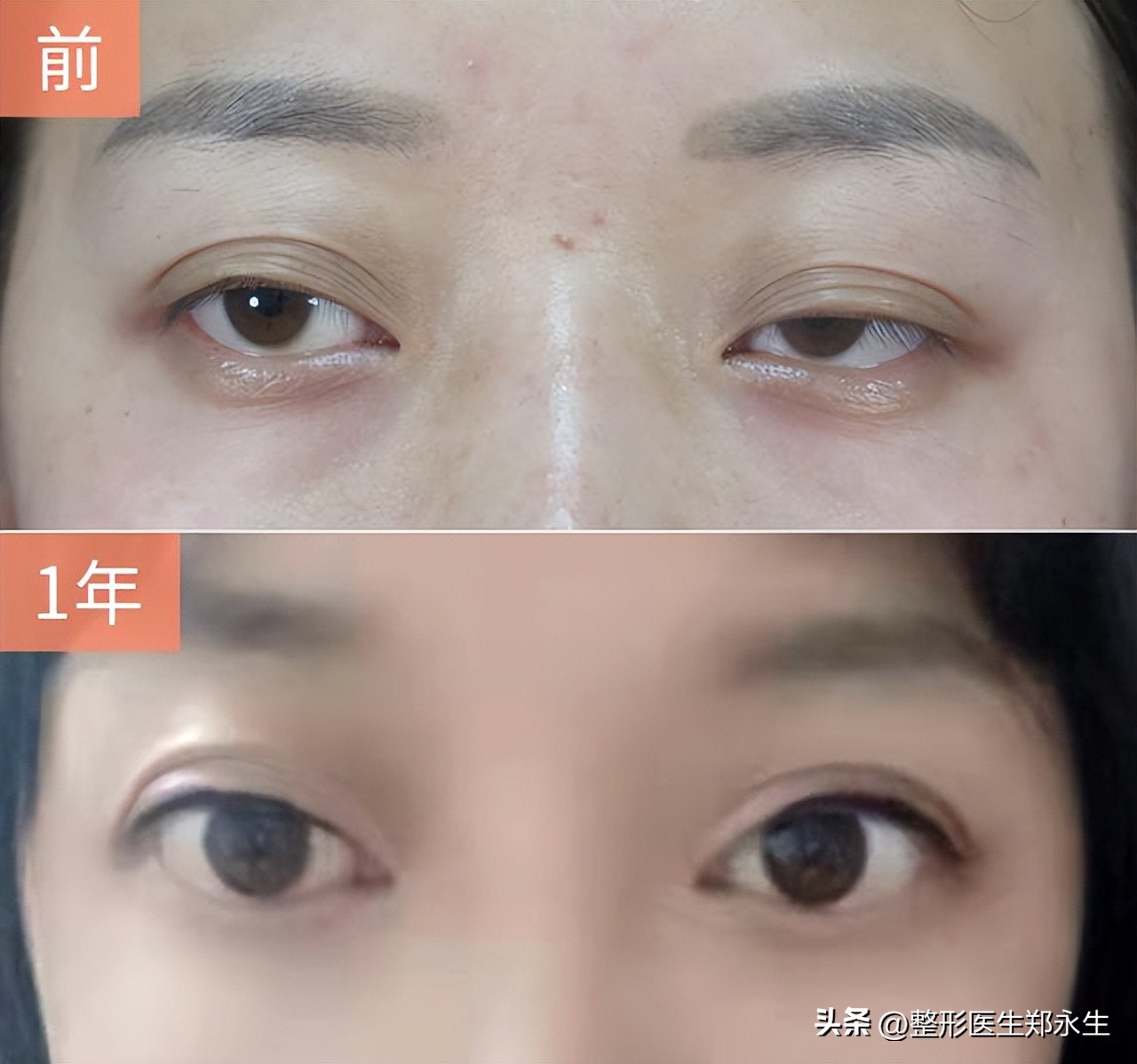 割双眼皮成了大小眼怎么办,双眼皮术后大小眼是什么原因