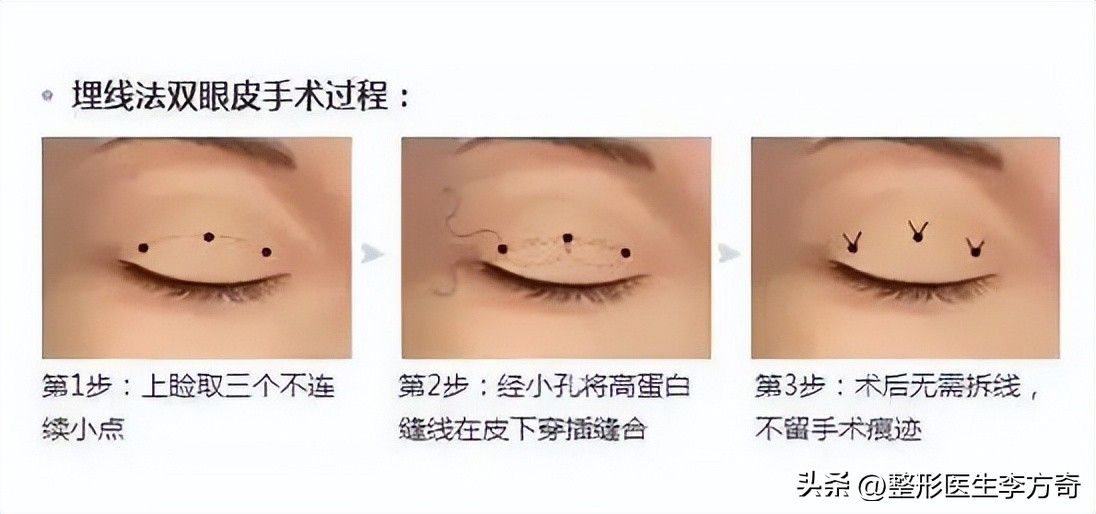 整形医院说双眼皮有几种技术,整形医生如何进行手术
