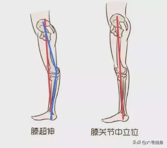 改善膝盖超伸的最佳方法,膝盖过膝超伸怎么治疗
