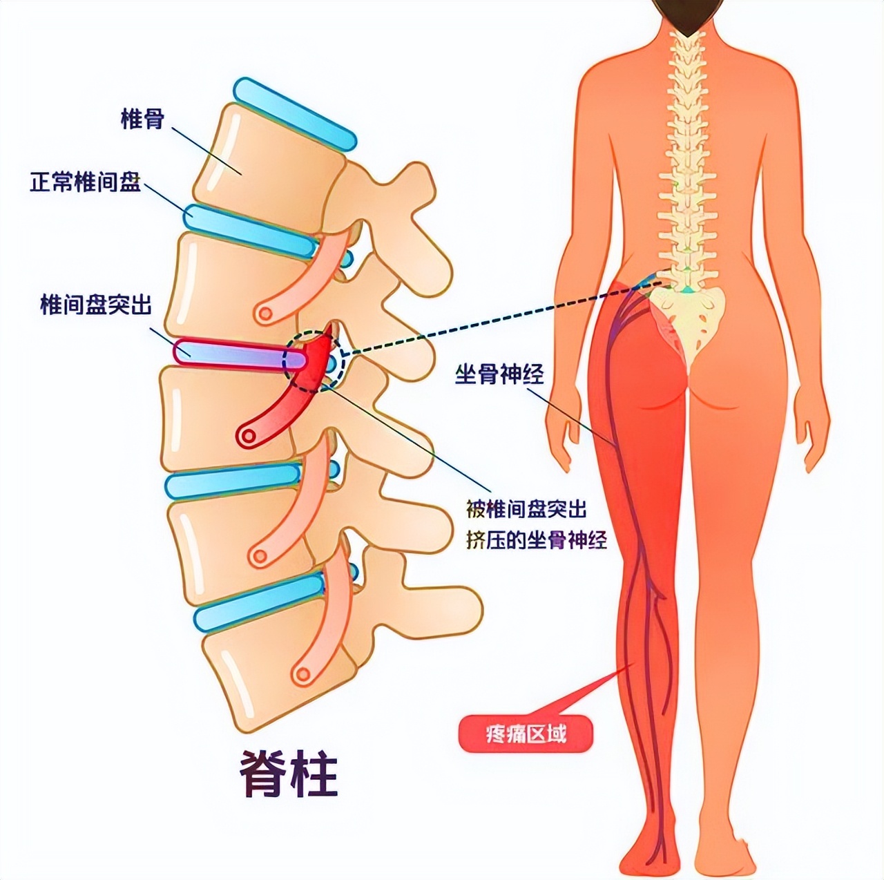 腰痛用热敷还是冷敷,腰痛该冷敷还是热敷