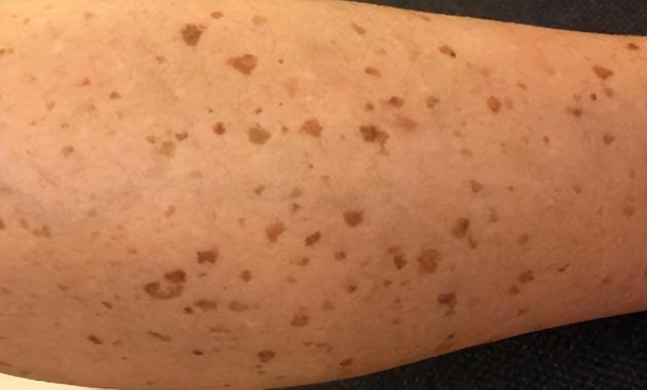 红霉素软膏真的能祛除老年斑吗,红霉素软膏去老年斑小妙招