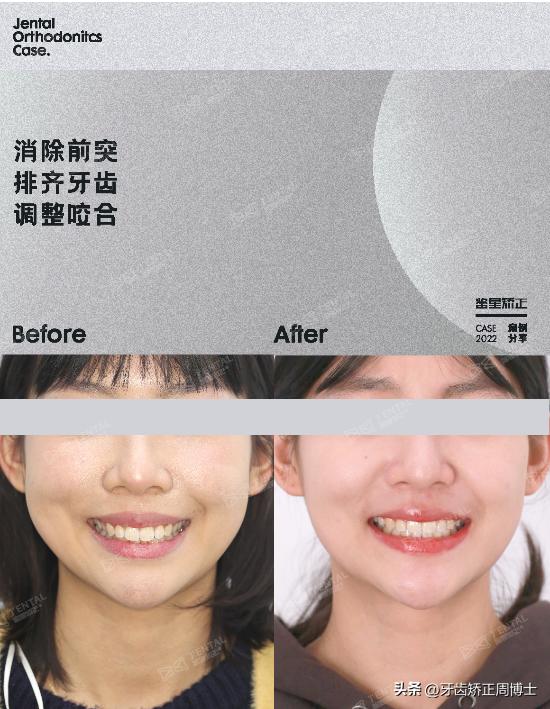 骨性龅牙矫正牙齿变小了,骨性龅牙已经做了正畸手术怎么办