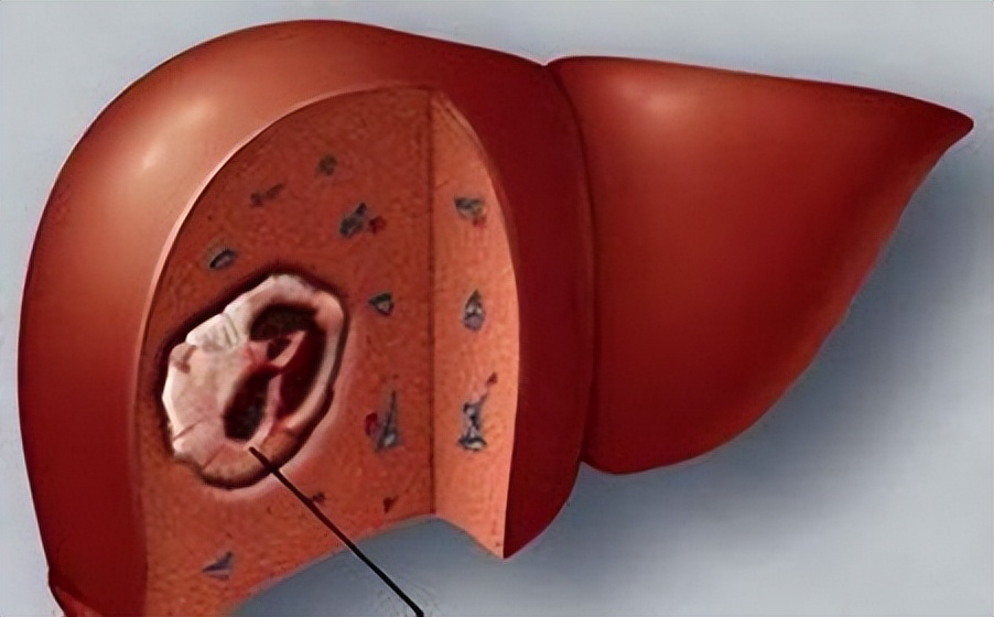 “打一针”治疗肝癌？湖北首例钇90微球治疗成功，花费或需30万