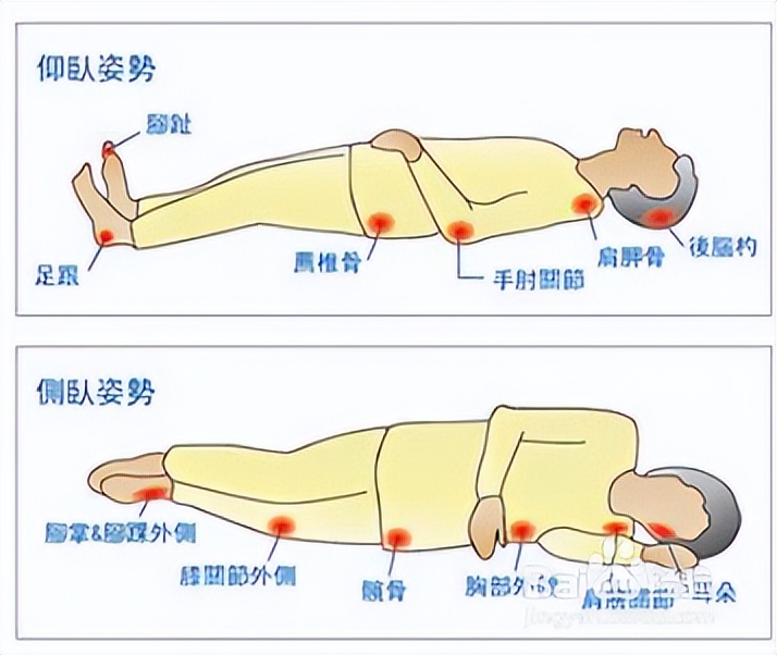 治褥疮的药膏有哪些,得了褥疮在家怎么治