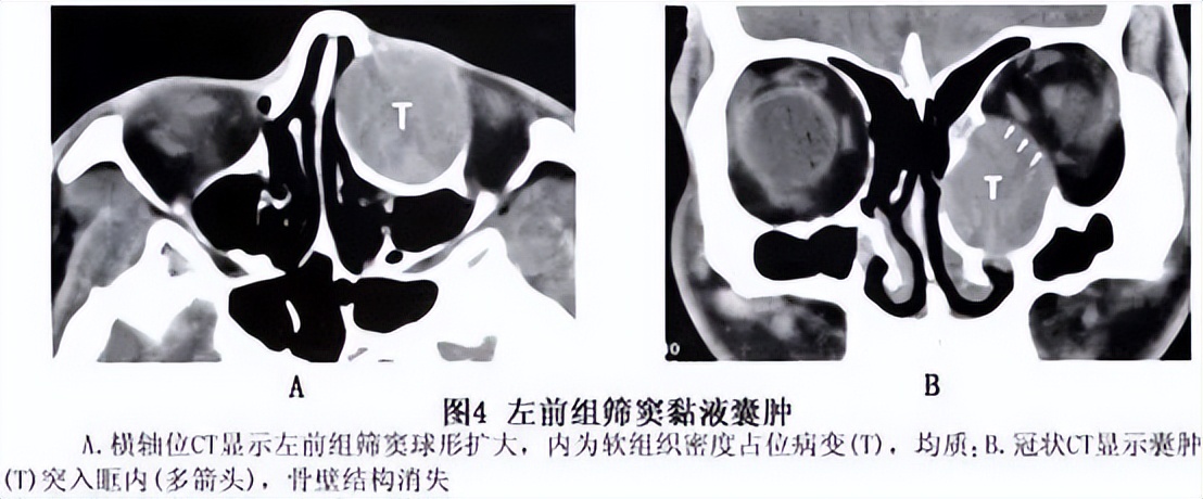 鼻窦浆液性囊肿症状,小石头学习