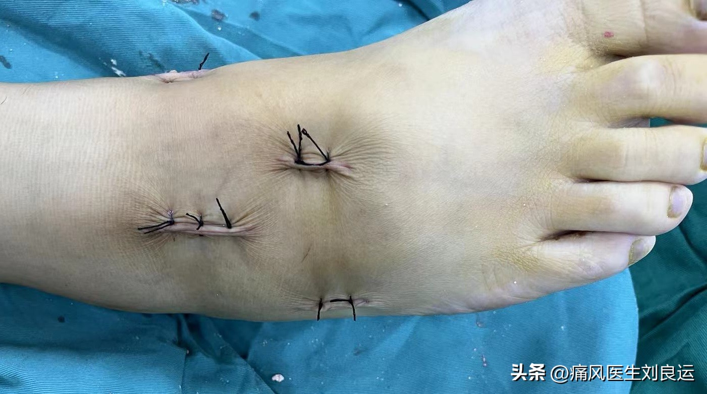 治疗痛风需要达标治疗，什么是痛风的达标治疗？从三方面做好管理