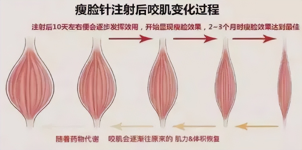 瘦脸针为什么可以瘦脸,瘦脸针真的能去皱吗