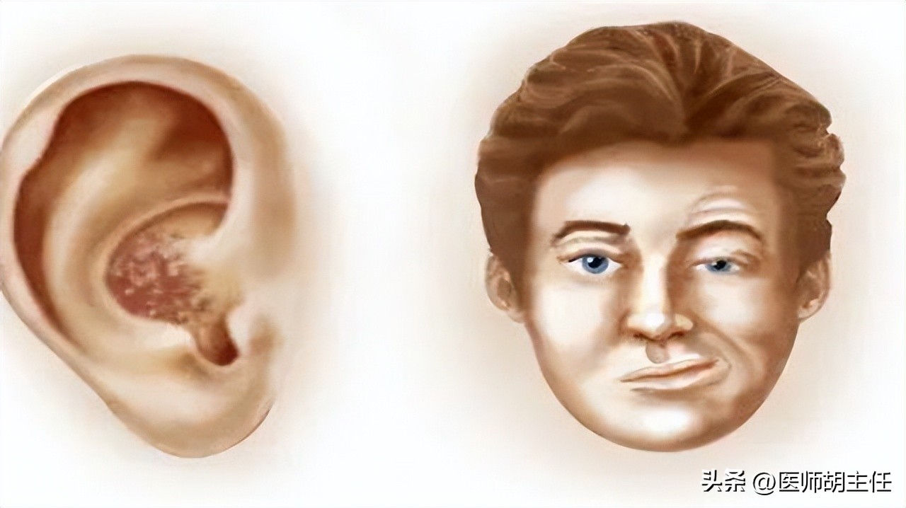 带状疱疹令人疼痛难忍该如何预防,哪些是带状疱疹患者要纠正的误区