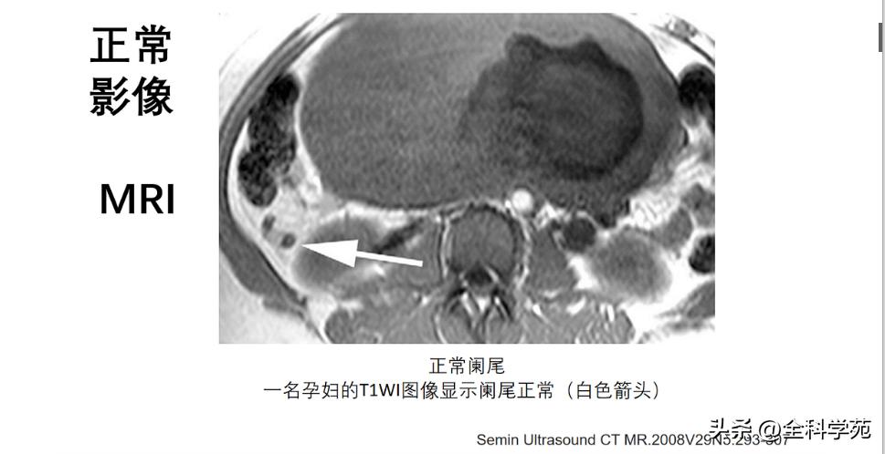 阑尾炎的讲解,关于阑尾炎的讨论总结