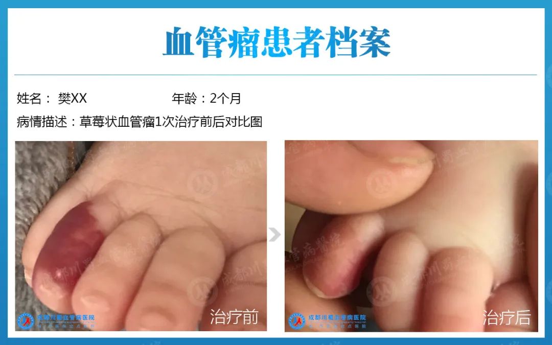 小红斑，*麻大**烦！警惕血管瘤健康隐患