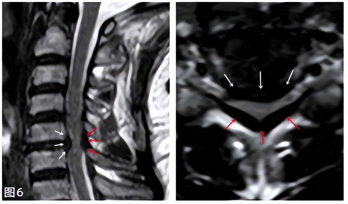 脊髓型颈椎病手术费用一览表,椎动脉型颈椎病手术风险多大