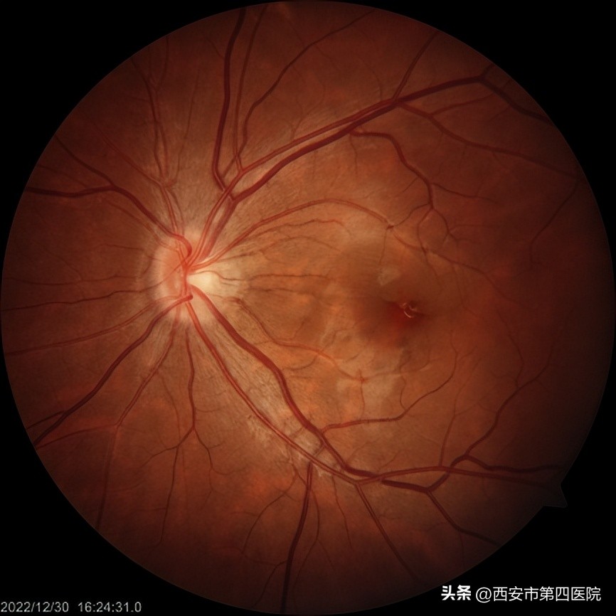 #新冠防疫手册#33岁女士“阳康”后视力下降、模糊、黑影……