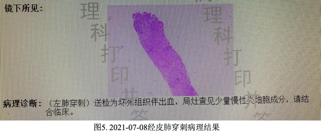 妇女双肺多发结节，病理示炎症，病情持续进展如何揭疑？