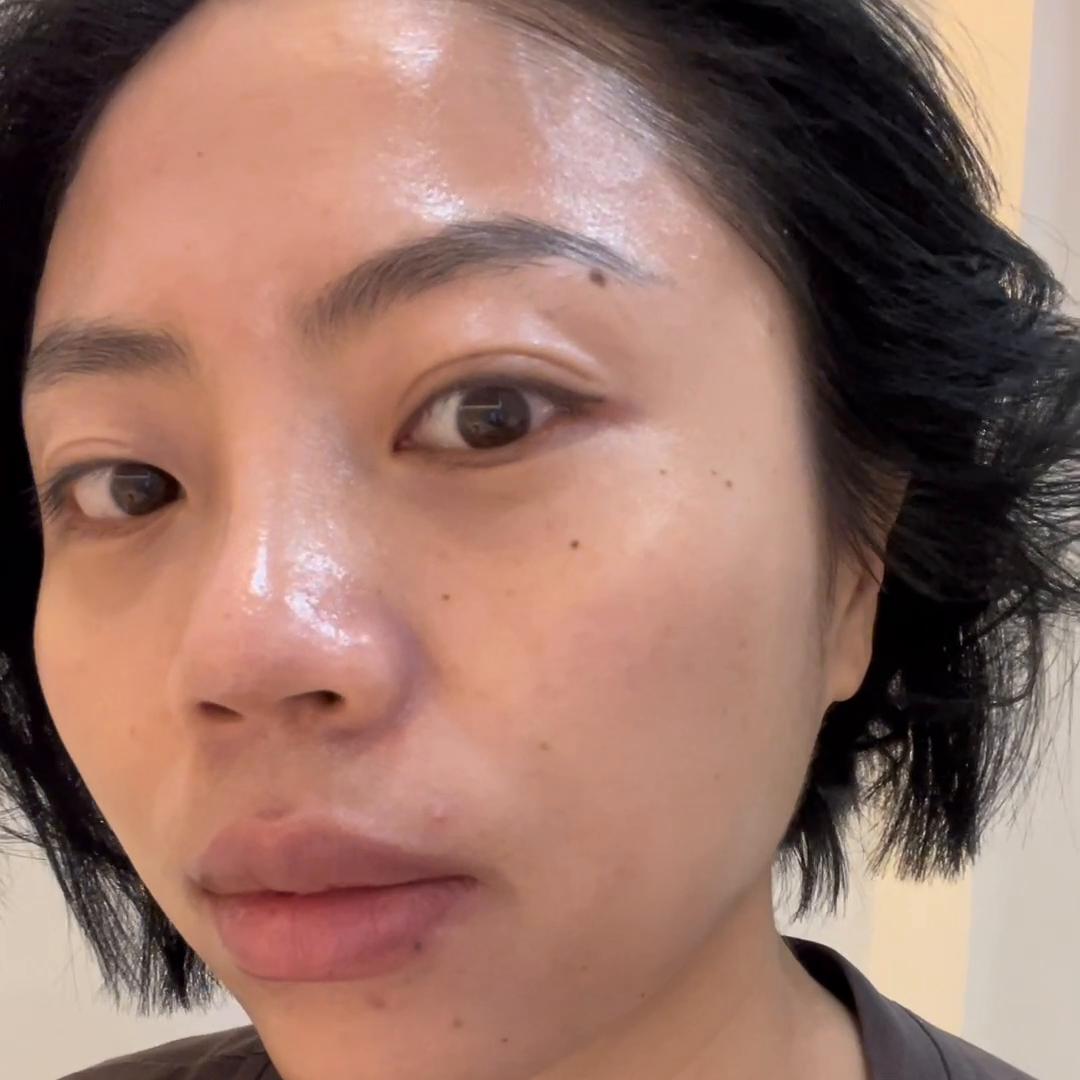 鼻子术后五个月了山根还是高,做完鼻子恢复后发现山根歪的