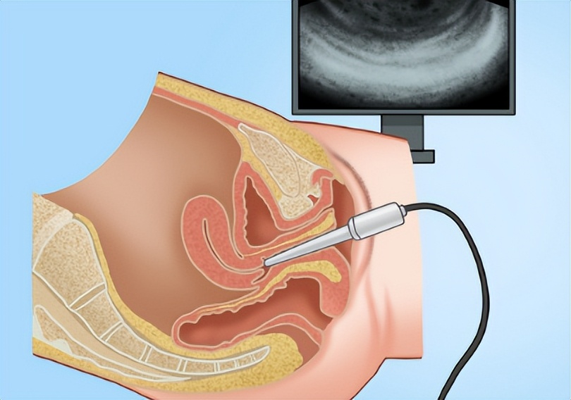 阴道镜检查VS阴式B超：妇科检查中的两大利器对比解析
