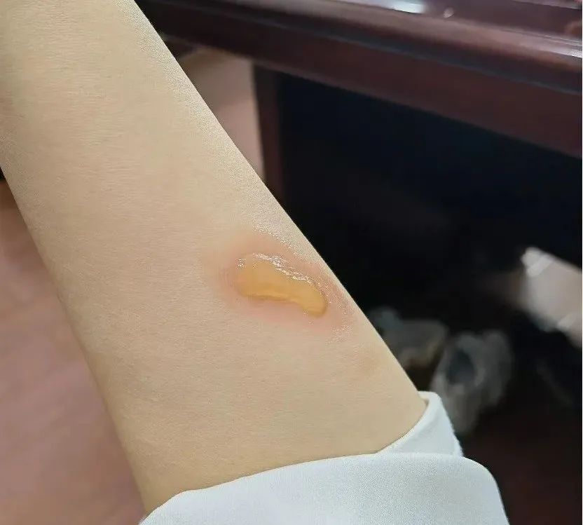 小孩不听话进厨房被烫伤,小朋友被油锅烫伤怎么办