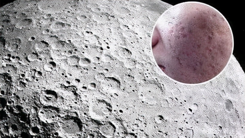 痤疮留下痘坑痘印怎么消除男生,男士修复痘印痘坑最好的护肤品