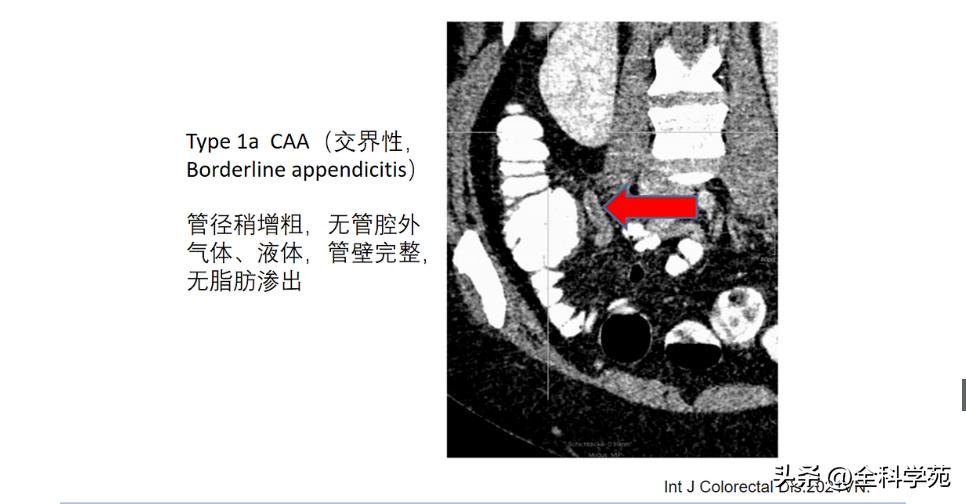阑尾炎的讲解,关于阑尾炎的讨论总结