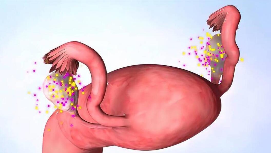 同房后酿成大错：黄体破裂！劝告：夫妻生活不是打仗，请务必适度