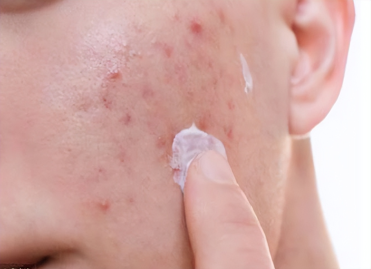 红霉素软膏副作用及注意事项,用红霉素软膏涂嘴唇要注意什么吗