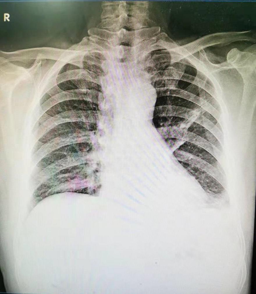 反复发烧但是拍片显示轻微肺炎,一直高烧39-40是肺炎么