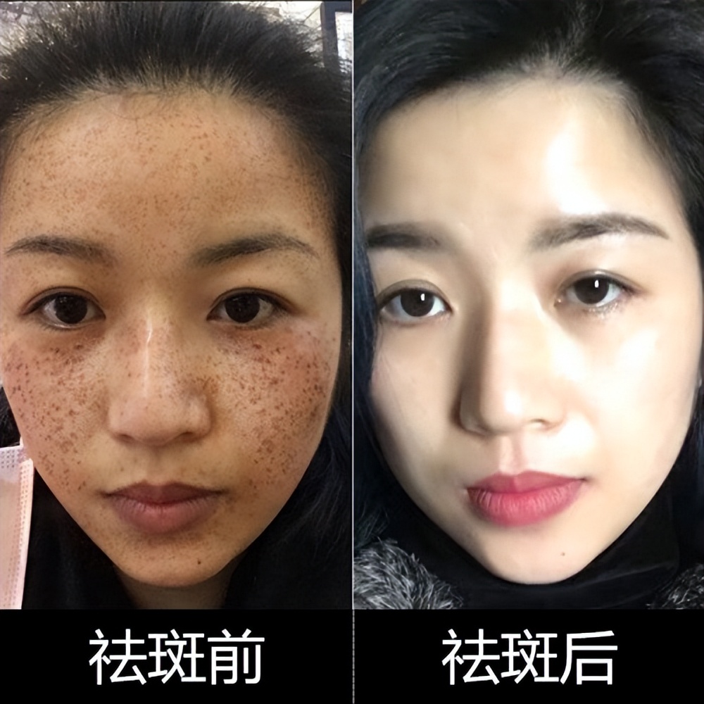 祛斑效果最好的排名第一,祛斑效果最好的排名第一名