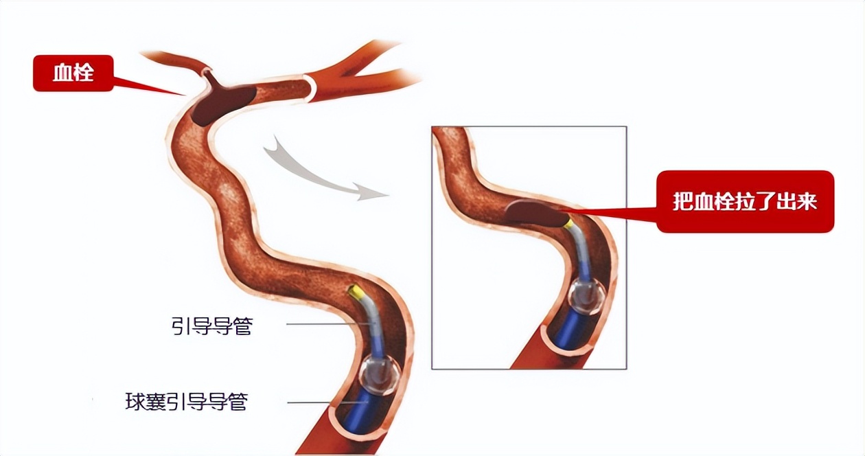 什么是溶栓/取栓时间窗？错过了还能恢复吗？
