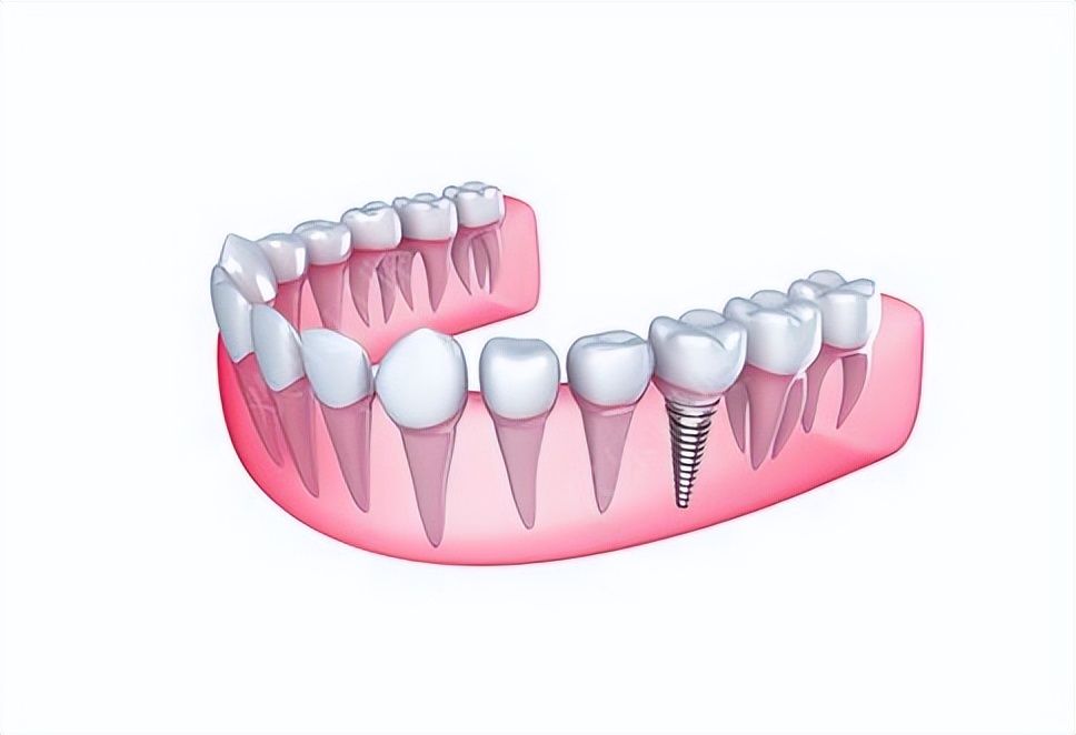 北京种植牙怎么操作,北京种植牙需要哪些步骤