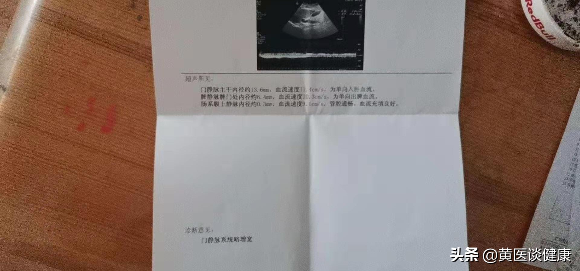 干扰素治疗乙肝降不下去了,干扰素治疗乙肝表面抗体超过10个