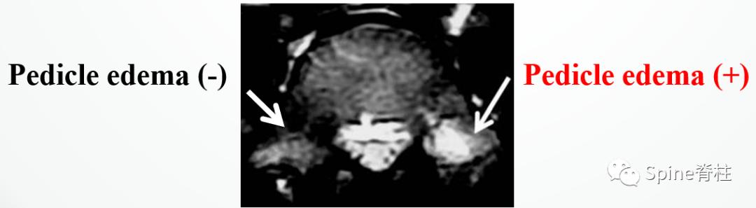 峡部裂和隐性峡部裂有区别吗,单纯峡部裂可以做峡部修复吗