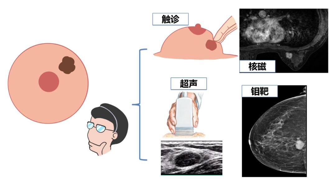 乳房有肿块并且疼痛要做穿刺,为什么医生让做乳腺穿刺