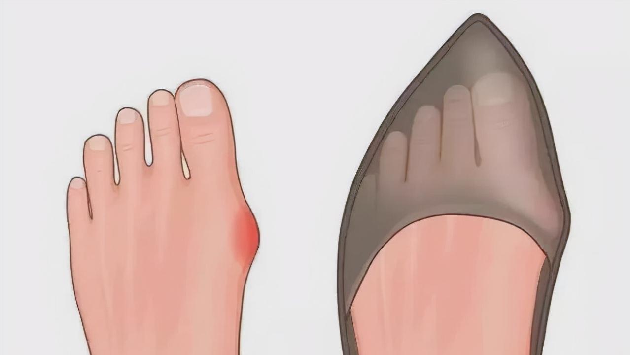 大拇脚趾外翻用什么矫正方法,大脚趾外翻歪怎么办