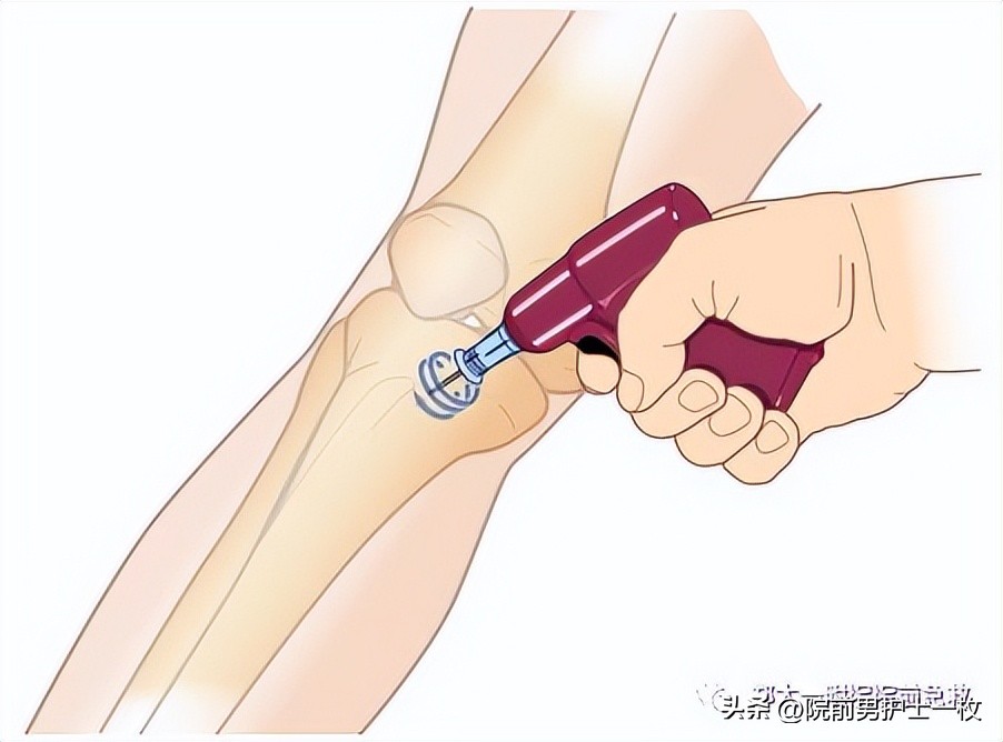 骨髓腔穿刺急救,骨髓腔穿刺适应症和禁忌症