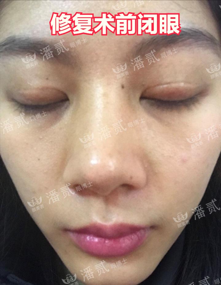 双眼皮贴导致眼皮破了,双眼皮贴导致眼皮严重下垂恢复