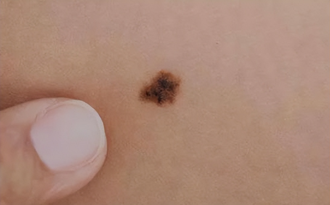 医生如何检查黑痣和黑色素瘤,医生长在摩擦部位的黑痣要当心