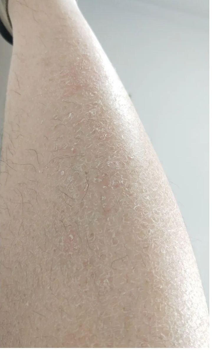 冬季皮肤干燥起皮有纹,皮肤干燥起蛇皮纹